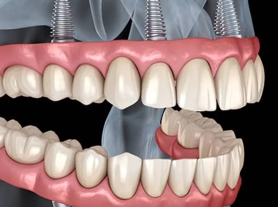 All-on-4 Implants in Las Vegas, NV: Your Solution for Missing Teeth