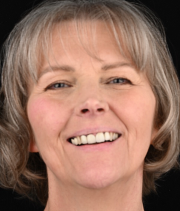 Carletta Full Face Before