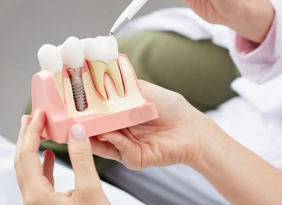 The Future of Smile Restoration: How Dental Implants Can Change Your Life