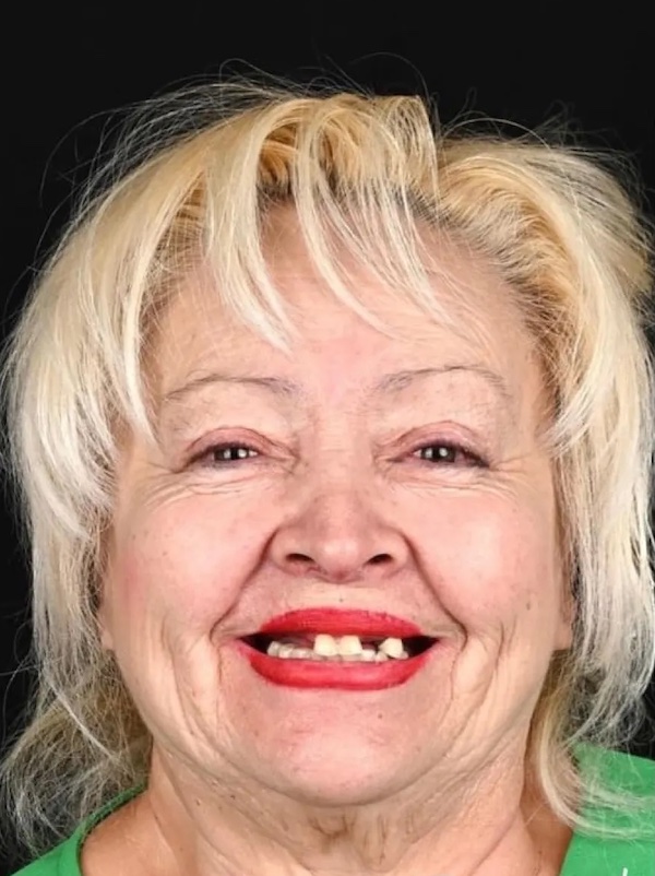 Leticia Full Face Before