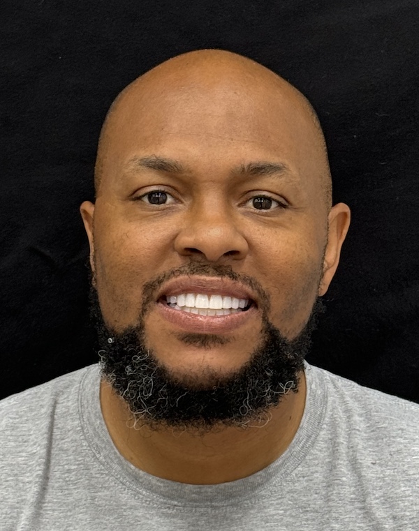 Ronique Full Face After