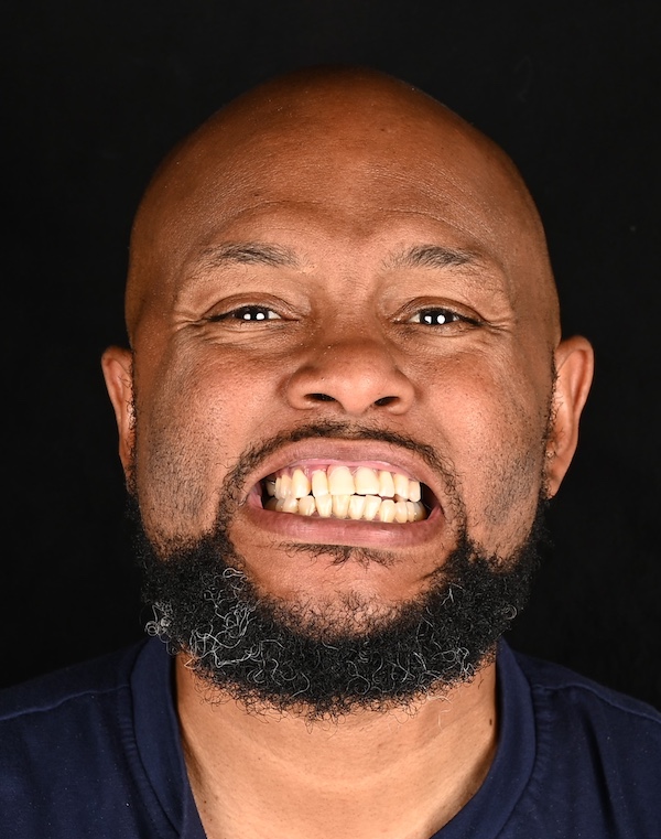 Ronique Full Face Before