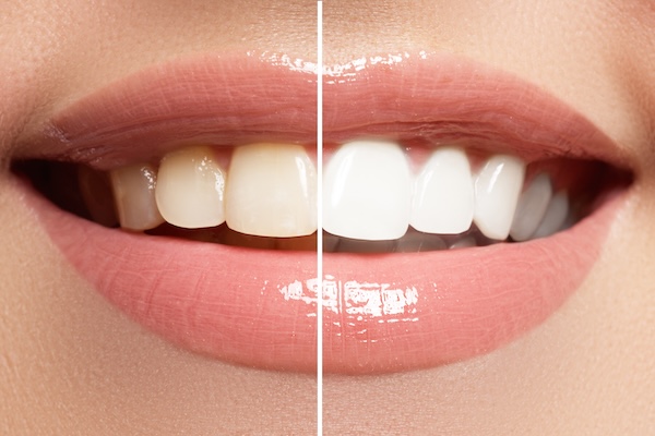 Top 5 Reasons to Choose Professional Teeth Whitening