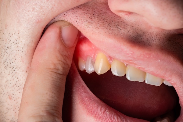 5 Signs You Need a Tooth Removed: When Extraction Becomes Necessary