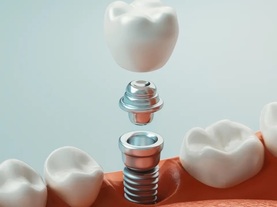 What Are Dental Implants?
