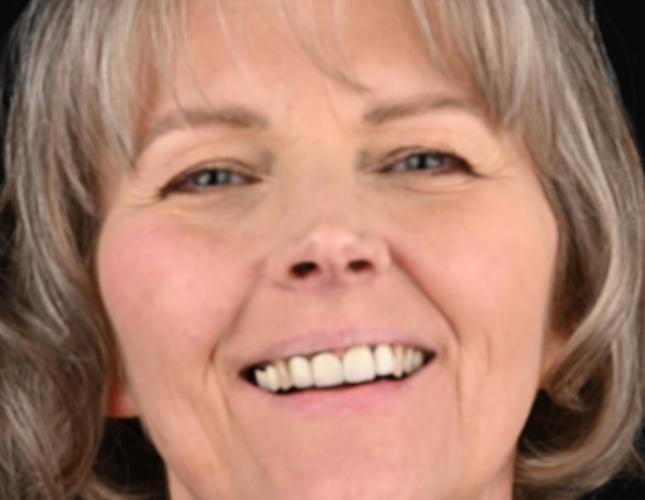 Carletta Full Face Before