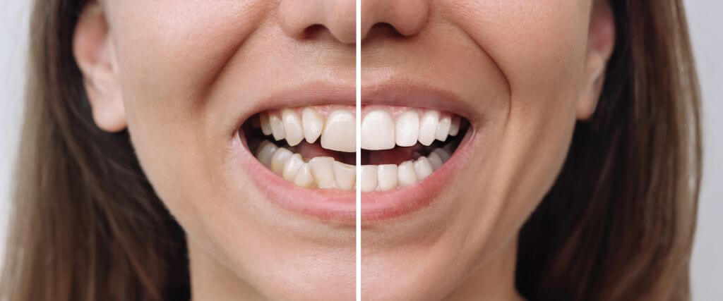 The Benefits of Cosmetic Dentistry: Procedures, Options, and Smile Enhancement